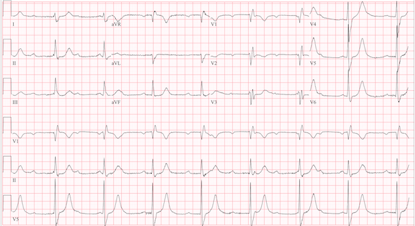 Tình huống ECG Tình huống ECG