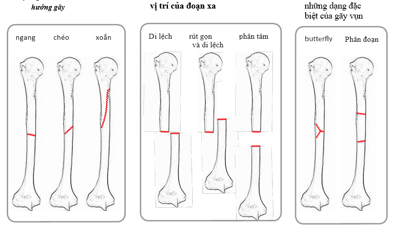 Phòng ngừa gãy xương di lệch